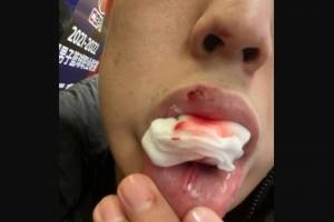 宋翔社媒晒沈梓捷伤情:嘴部几处被打破 咬纱布打全场